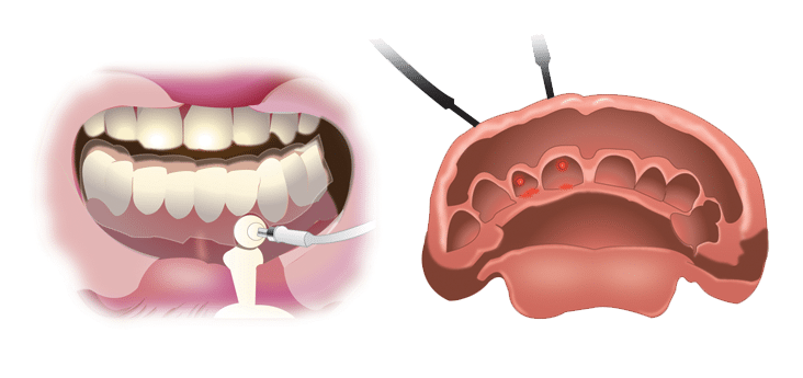 Oral Cavity Measurement illustration